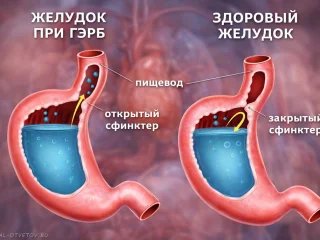 Гастроэзофагеальная рефлюксная болезнь (ГЭРБ): причины, симптомы, лечение