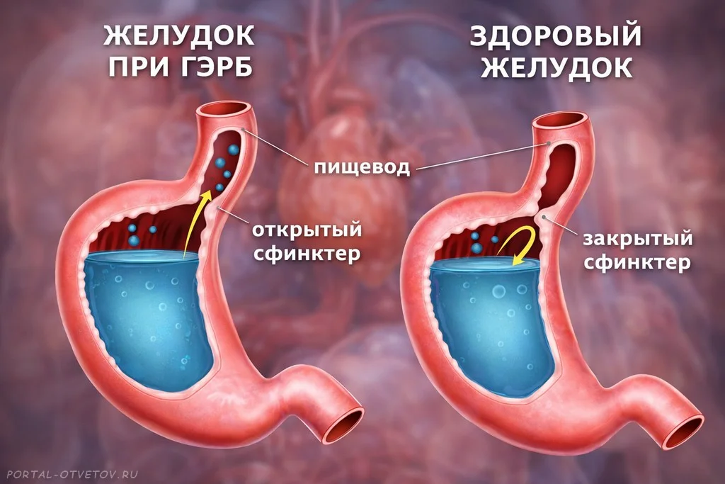 Желудок при ГЭРБ и здоровый желудок