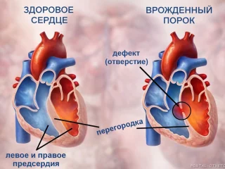 Что из себя представляет врождённый порок сердца?